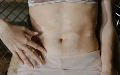 Vitiligo: Causes, Symptoms, And Treatments