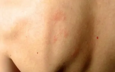 Common Springtime Skin Allergies and Treatments