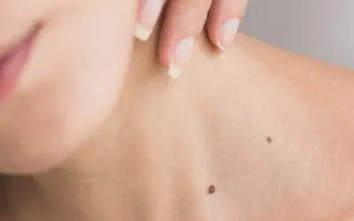 Crossing the Bridge Between High Blood Pressure and Psoriasis