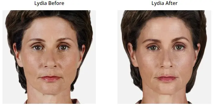 Volbella Before and After Pictures Phoenix, AZ