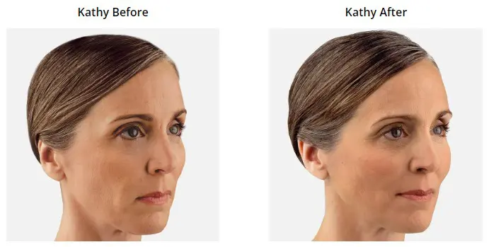 Voluma Before and After Pictures Phoenix, AZ