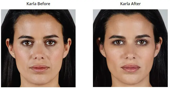 Vollure Before and After Pictures Phoenix, AZ