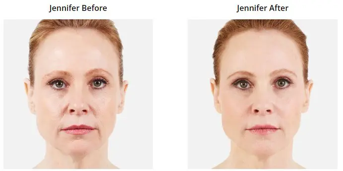 Ultra Before and After Pictures Phoenix, AZ