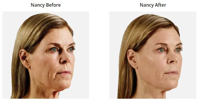 Voluma Before and After Pictures Phoenix, AZ