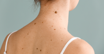 Arizona’s High Melanoma Rates and What You Can Do