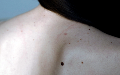 Why SRT Is the Future of Non-Melanoma Treatment