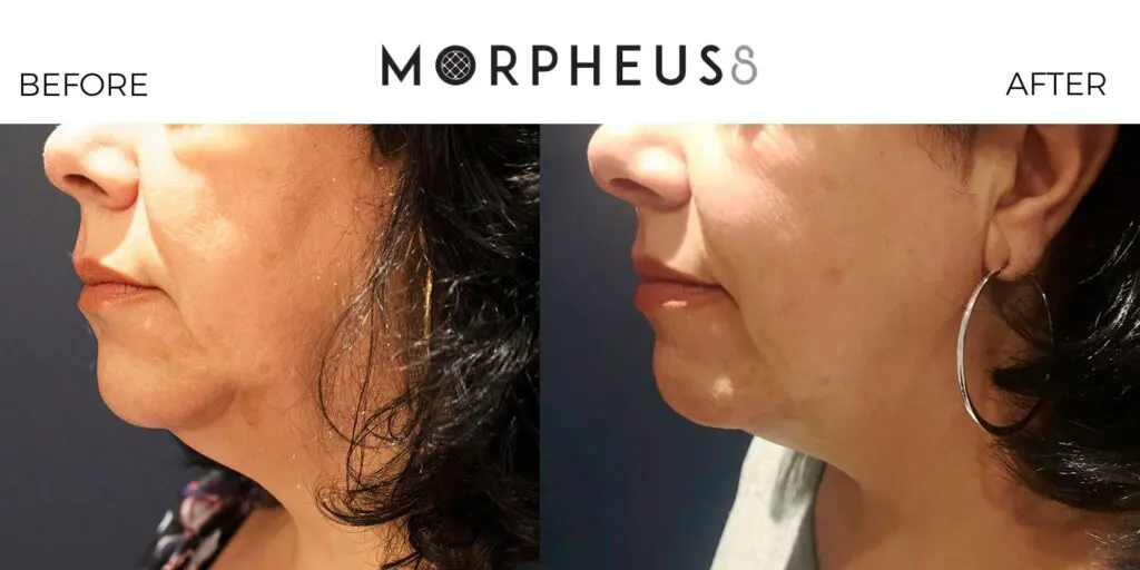 A before and after shot of the side of a woman's face after a Morpheus8 treatment