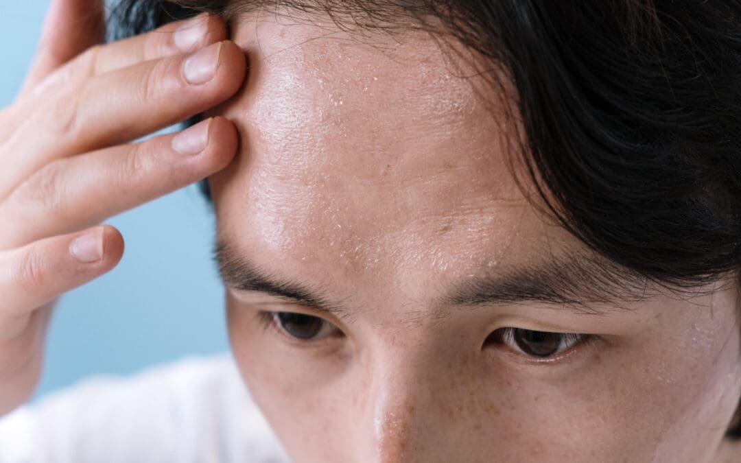 Hyperhidrosis: How Can I Stop My Excessive Sweating