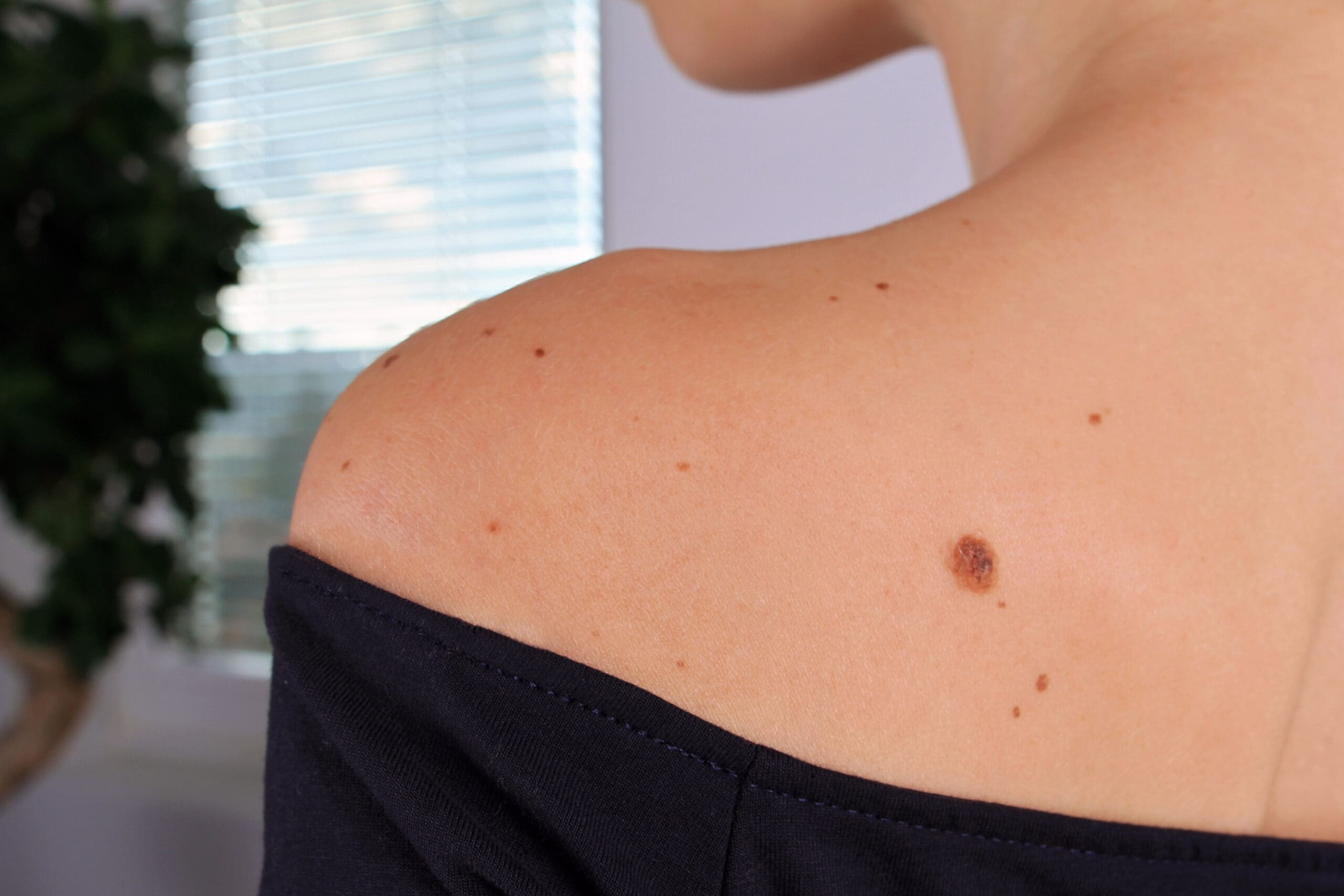 Woman with birthmarks on her skin.Skin tags removal. Skin Tags in Phoenix, AZ