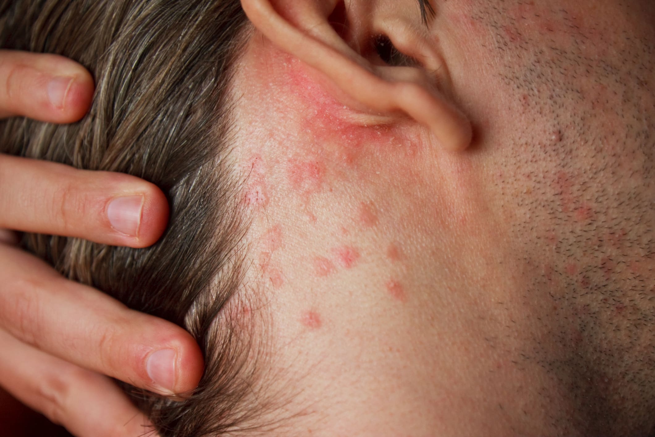 Rash Psoriasis in Phoenix, AZ