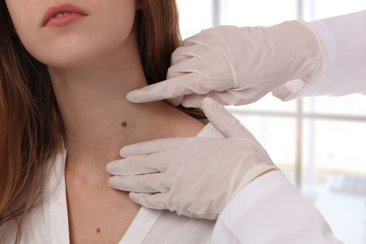 Doctor dermatologist examines birthmark of patient close up. Checking benign moles. Laser Skin tags removal Moles in Phoenix, AZ