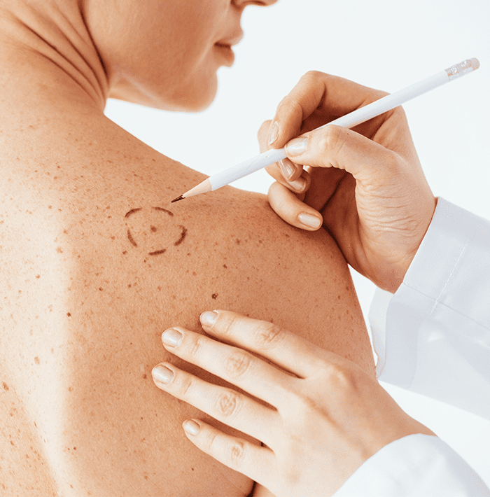 Mohssurgery12 acne